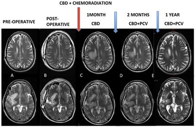 Case Report: Clinical Outcome and Image Response of Two Patients With Secondary High-Grade Glioma Treated With Chemoradiation, PCV, and Cannabidiol